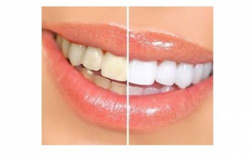 Cridaro - Produkt Aparat de albire - dinti albi in 10 minute, la doar 27 ron in loc de 54 ron
